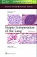 Biopsy Interpretation of the Lung Second edition