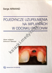 Pojedyncze uzupełnienia na implantach w odcinku przednim