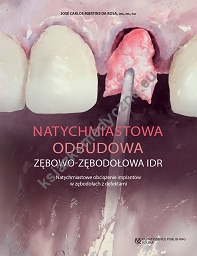 Natychmiastowa odbudowa zębowo-zębodołowa IDR