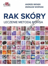 Rak skóry. Leczenie metodą Mohsa