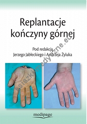 Replantacje kończyny górnej