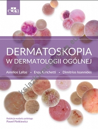 Dermatoskopia w dermatologii ogólnej